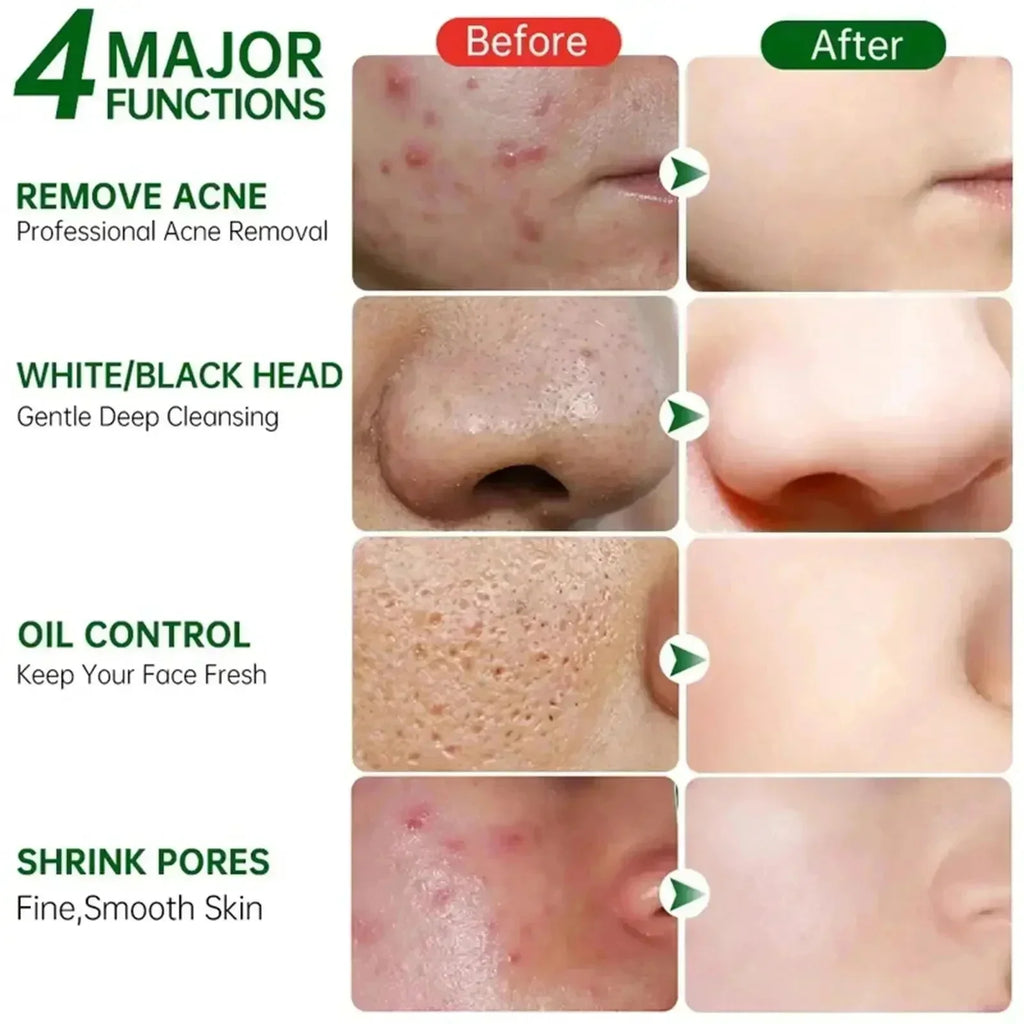 Salicylic Acid Pore Clearing Cream Shrink Pores Remove Blackheads Acne Brighten Moisturizing Smooth Skin Care Korean Products