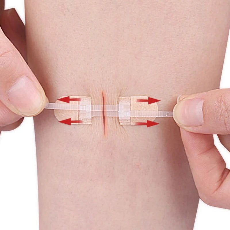 For Wound Care Braces Supports Strap Zipper Wound Closure Patches Breathable Seamless Elastic Zip Sutures Bandages