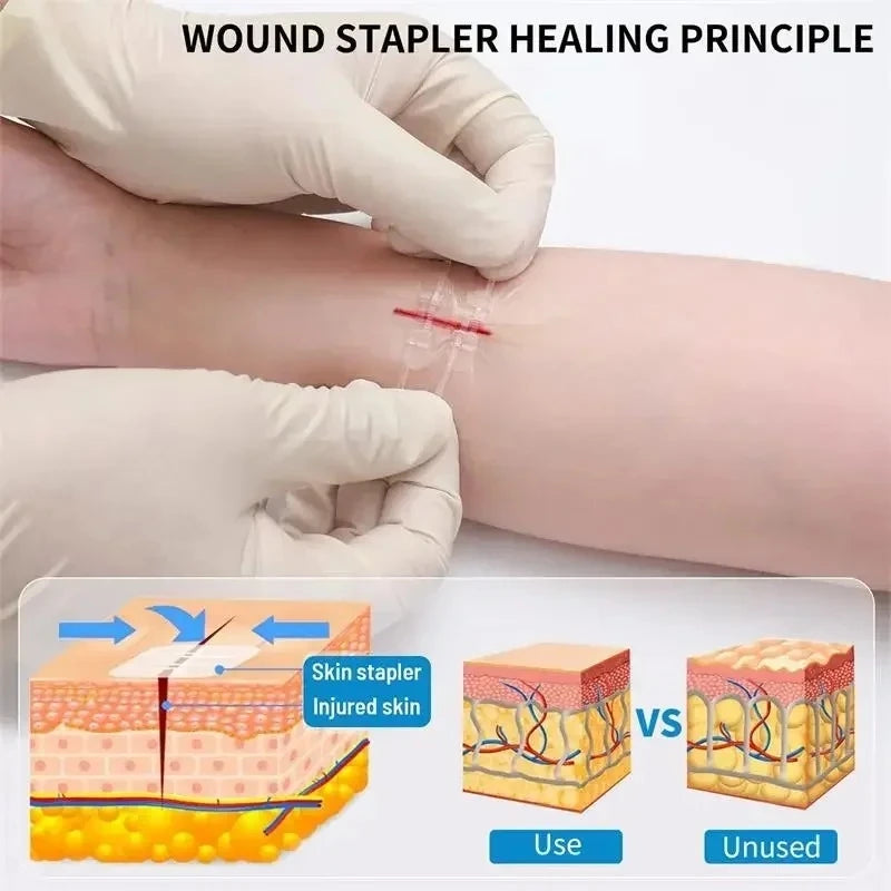 10 Pieces of Outdoor Camping Home Zipper Hemostatic Tape, Wound Closure Tape, Quick Suture Zipper Adhesive Tape, Easy to Carry
