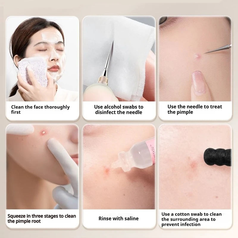 Surgical Steel Blackhead Remover Pimple Popper Acne Comedone Extractor Fine Needle Tips Pore Cleaner Deep Cleaning Facial Tool