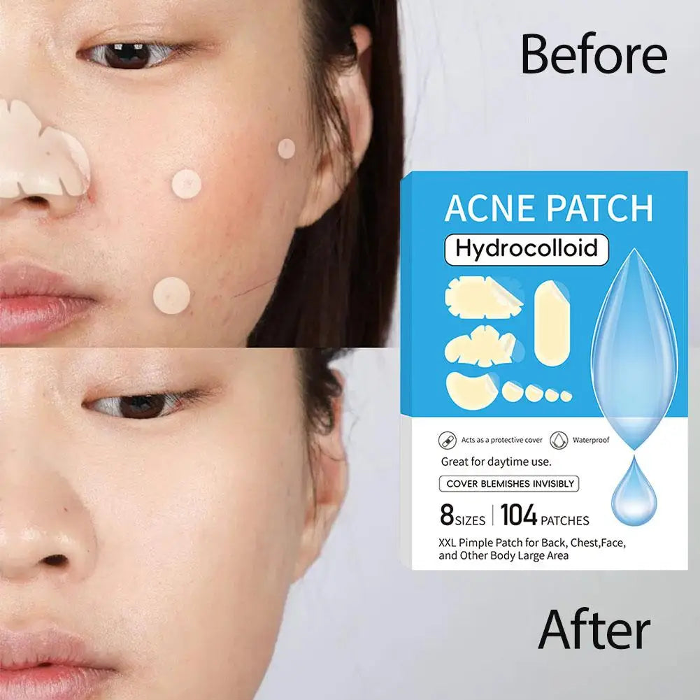 Large Pimple Patches Bulk for Face, 9 Styles Hydrocolloid Acne Patches for Covering Body, Forehead, Chin Blemishes Zit Breakouts