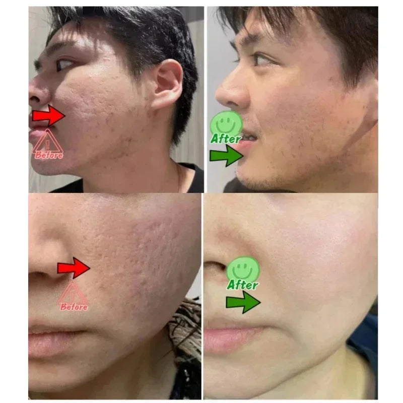 Salicylic Acid Pore Clearing Cream Shrink Pores Remove Blackheads Acne Brighten Moisturizing Smooth Skin Care Korean Products
