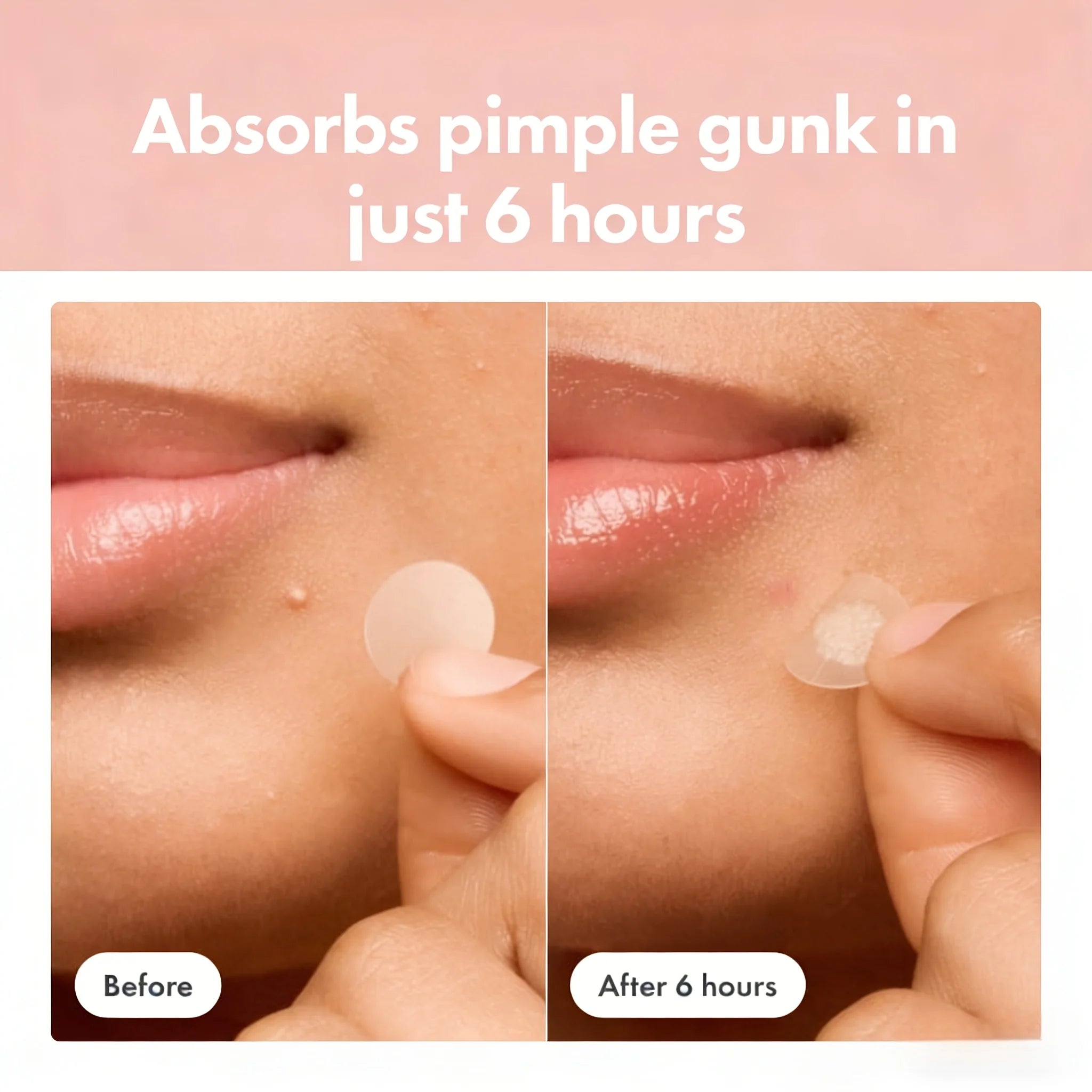 400pcs Hydrocolloid Acne Pimple Patches for Face, Effective Blemish Spot Treatment, Invisible & Skin-Friendly